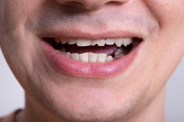 What Options Are Available For A Broken Tooth?