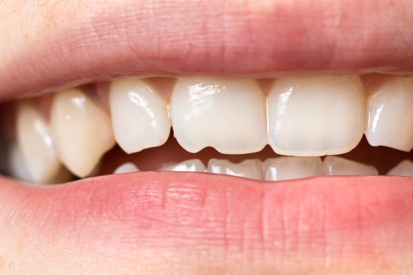 Does A Chipped Tooth Require A Root Canal?