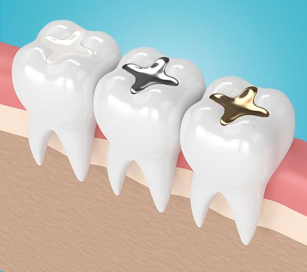 Federal Way Composite Fillings