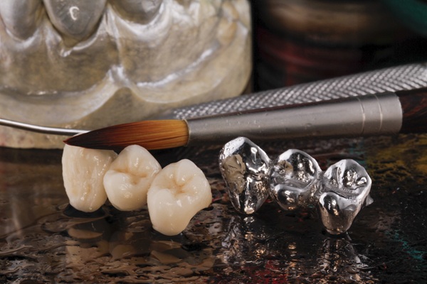 Dental Bridges: A Lasting Solution For Missing Teeth
