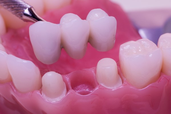 Oral Hygiene Routines For Dental Bridges