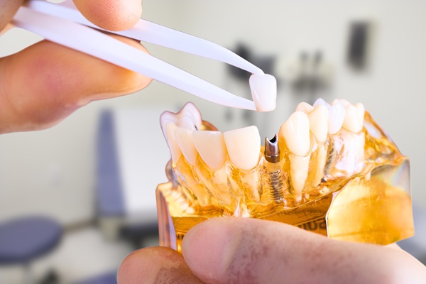 Oral Surgery For Dental Implant