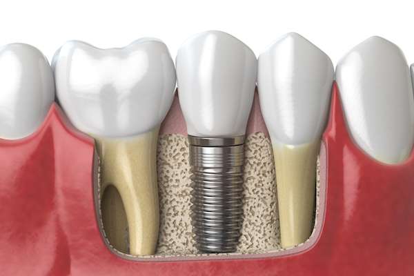 Dental Implants for Replacing Missing Teeth from Smile Center Dental Care in Federal Way, WA