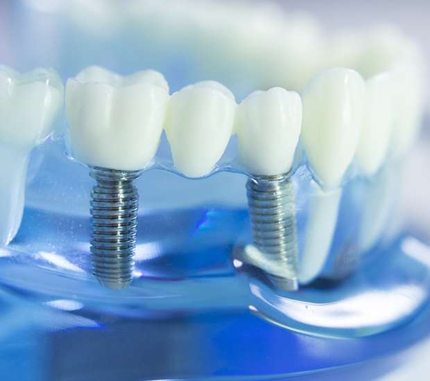 Federal Way Dental Implants