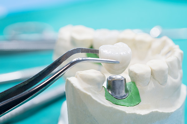 General Dentistry Solutions Using Dental Crowns from Smile Center Dental Care in Federal Way, WA