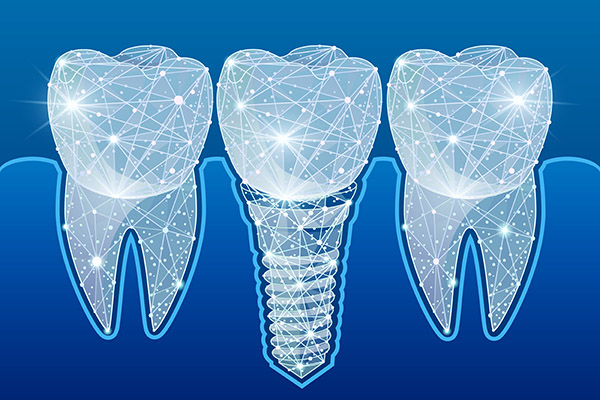 Preventing Complications After Getting Dental Implants